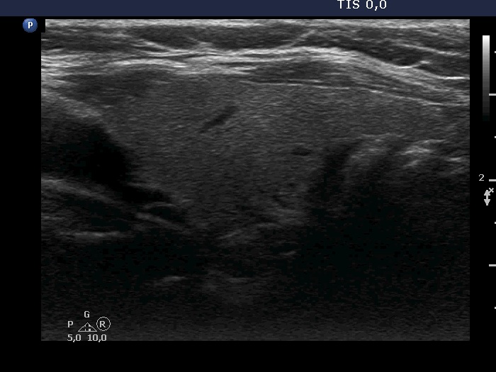 Right lobe, longitudinal scan