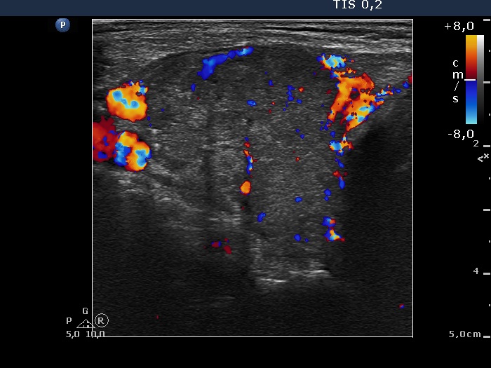 Right lobe, longitudinal scan