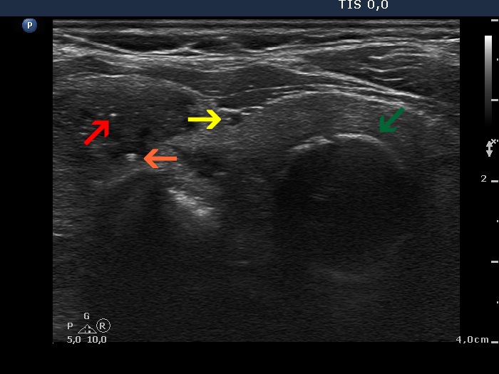 Right lobe, longitudinal scan