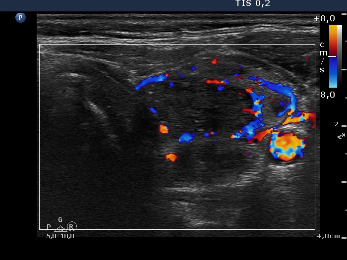 Right lobe, longitudinal scan