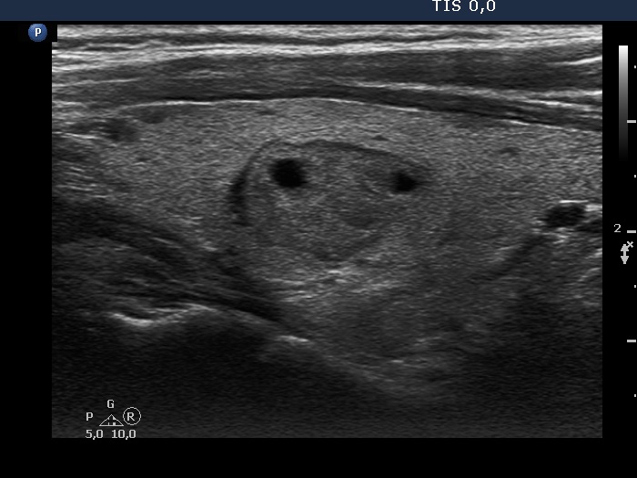 Right lobe, longitudinal scan