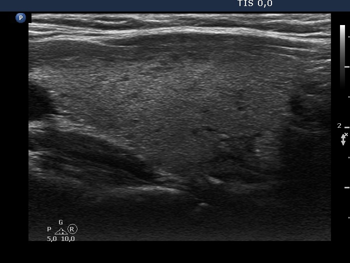 Right lobe, longitudinal scan