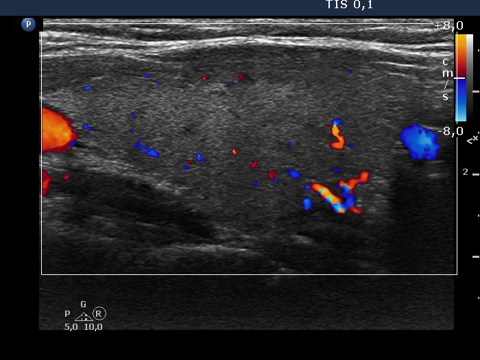 Right lobe, longitudinal scan