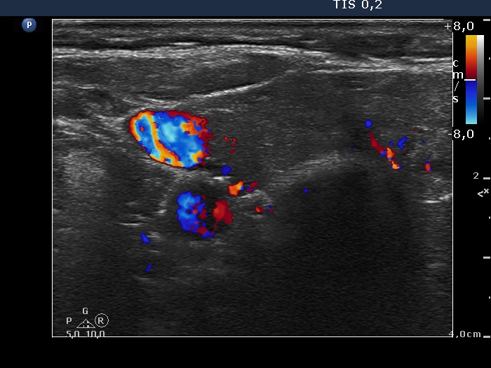 Right lobe, longitudinal scan