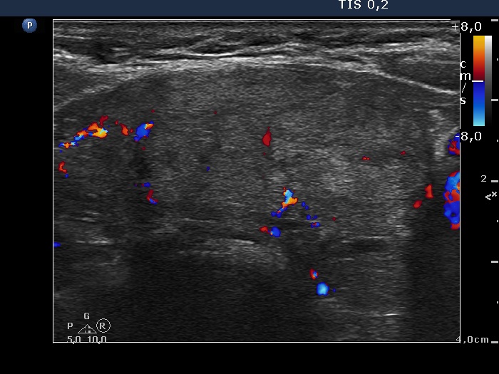Right lobe, longitudinal scan
