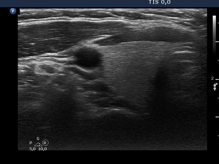 Right lobe, longitudinal scan