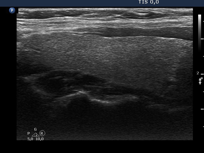 Right lobe, longitudinal scan