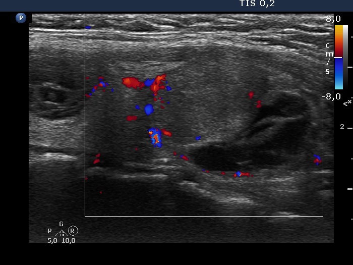 Right lobe, longitudinal scan