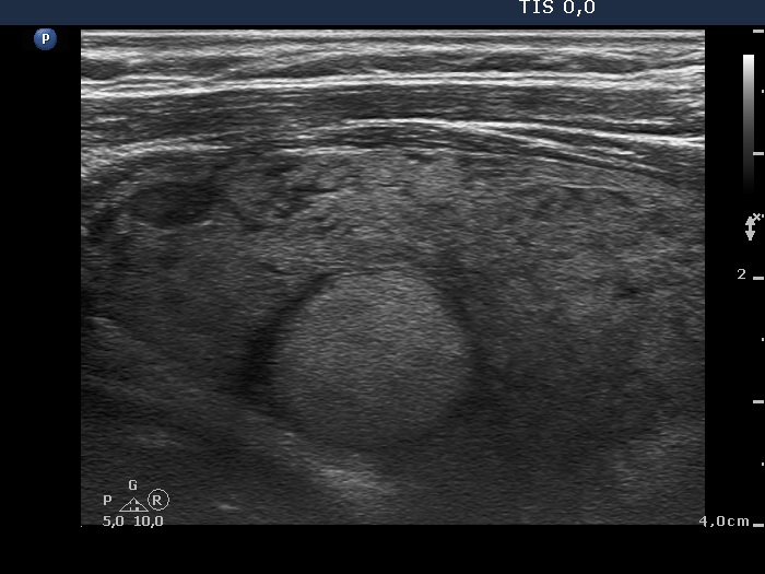Right lobe, longitudinal scan