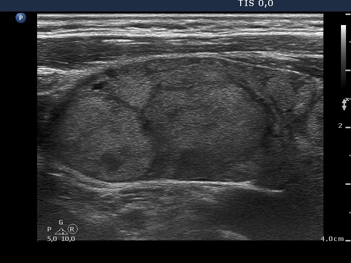 Right lobe, longitudinal scan