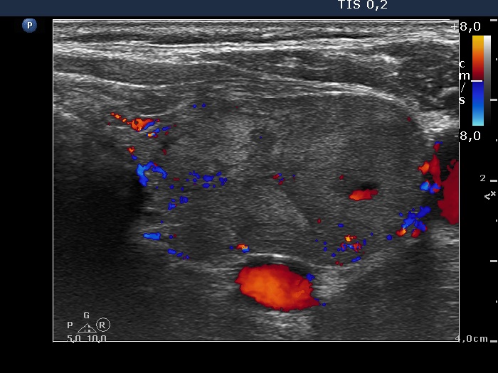 Right lobe, longitudinal scan