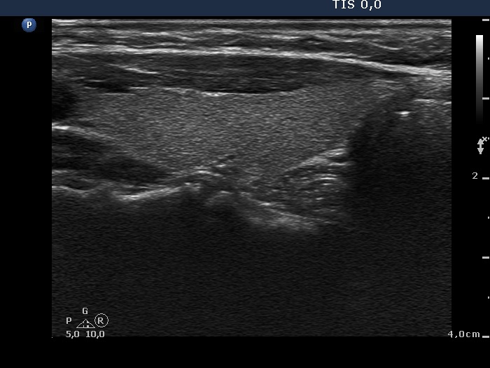 Right lobe, longitudinal scan