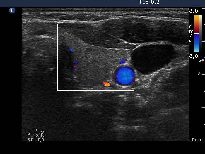 Right lobe, longitudinal scan