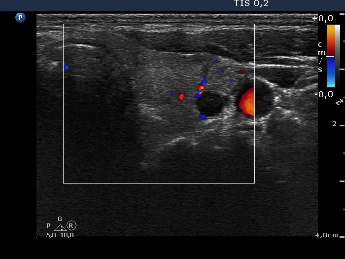 Right lobe, longitudinal scan