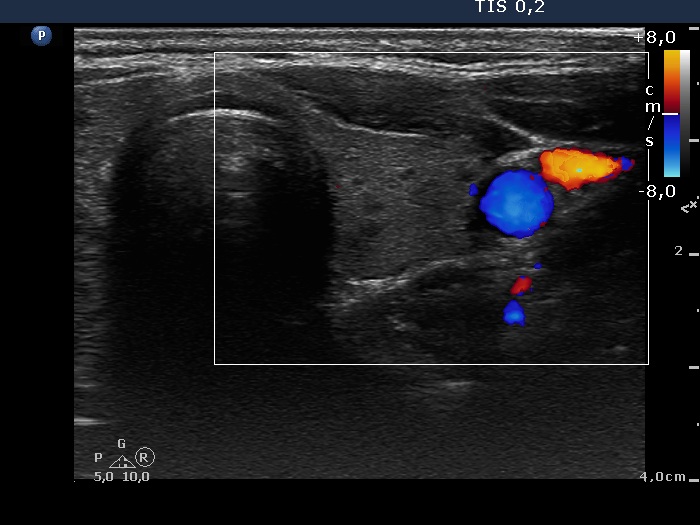 Right lobe, longitudinal scan