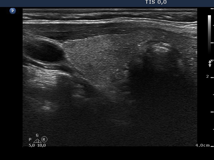 Right lobe, longitudinal scan
