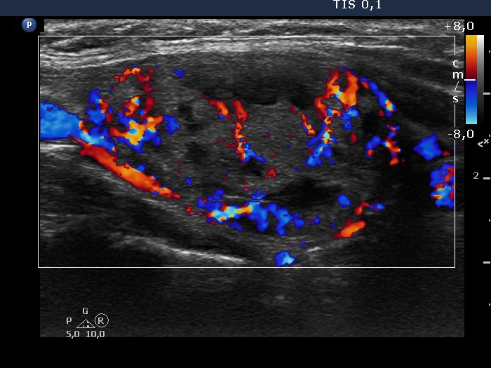 Right lobe, longitudinal scan