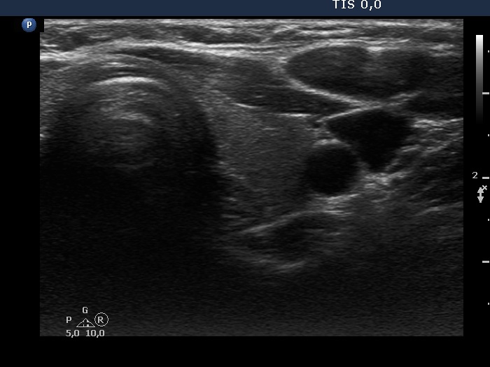 Right lobe, longitudinal scan