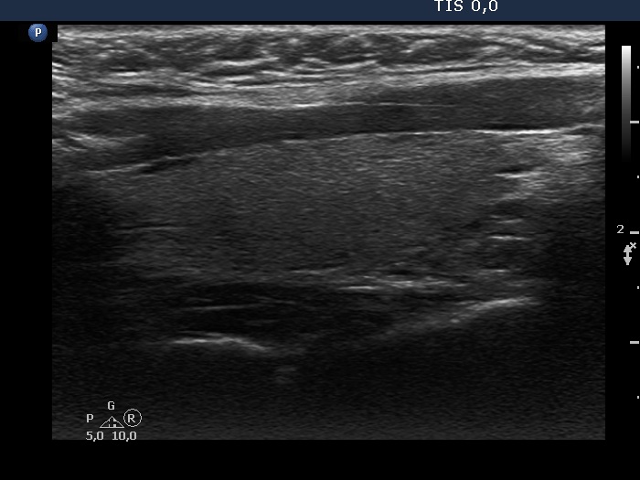 Right lobe, longitudinal scan