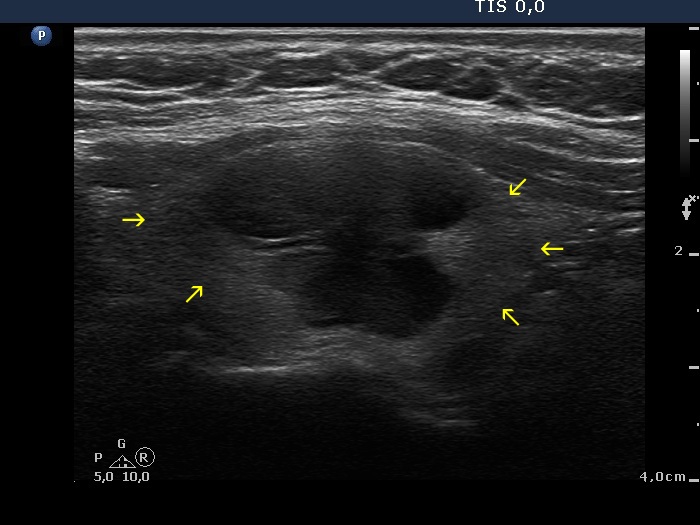 Right lobe, longitudinal scan