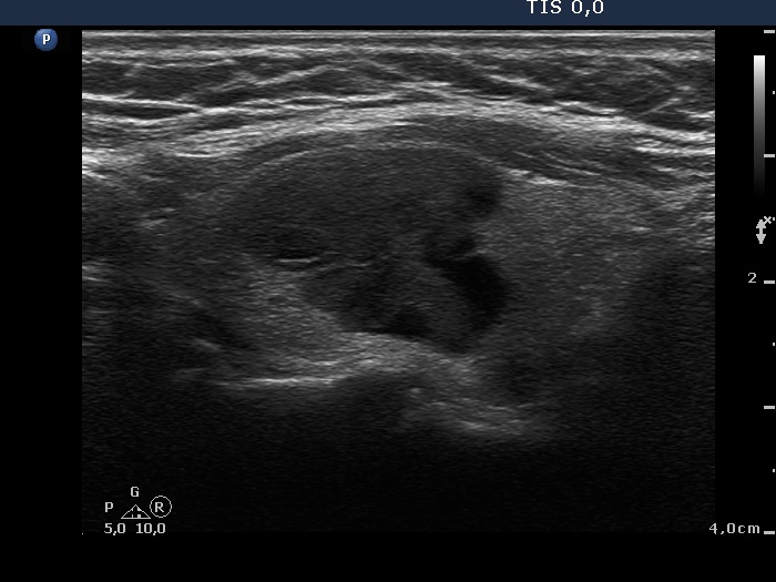 Right lobe, longitudinal scan
