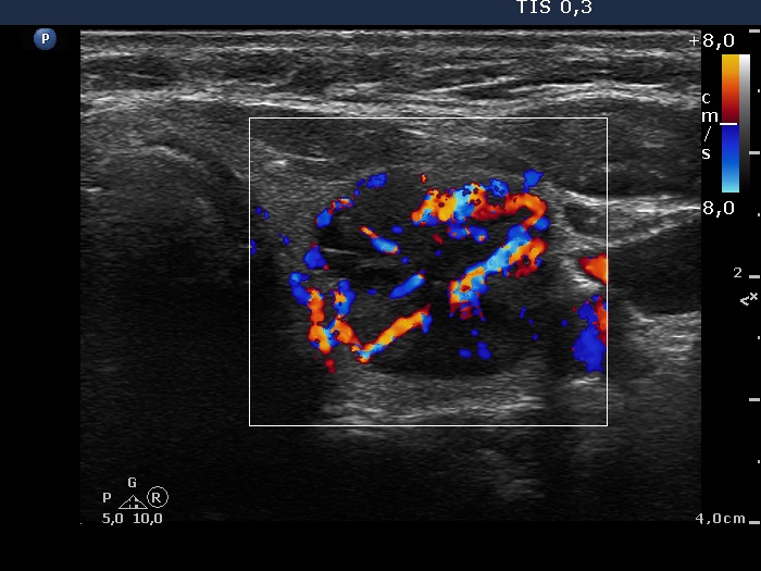 Right lobe, longitudinal scan