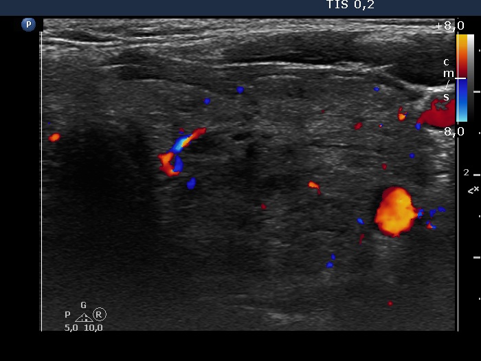Right lobe, longitudinal scan