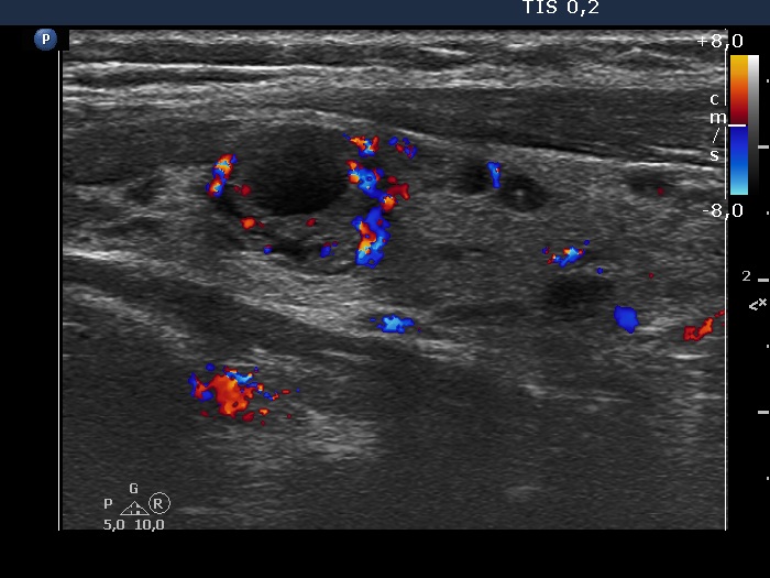 Right lobe, longitudinal scan