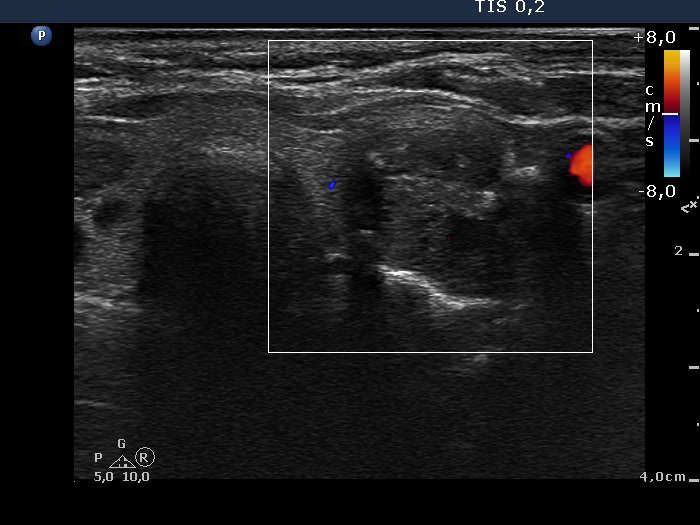 Right lobe, longitudinal scan