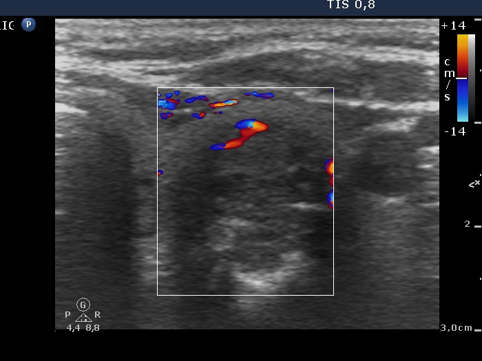 Right lobe, longitudinal scan