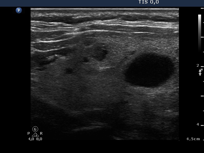 Right lobe, longitudinal scan