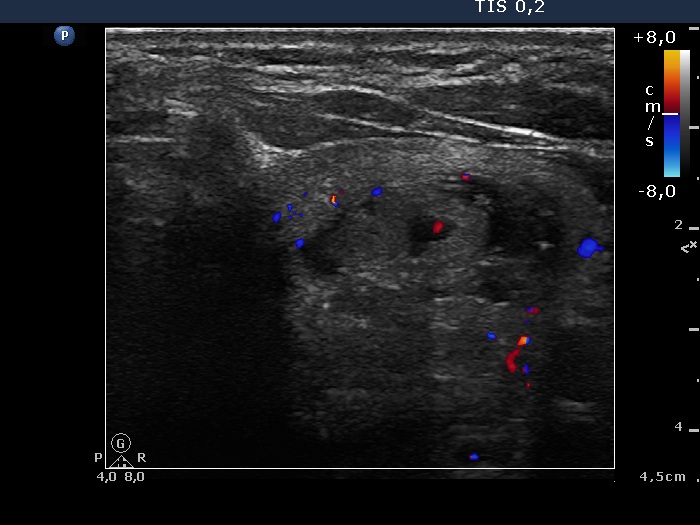 Right lobe, longitudinal scan