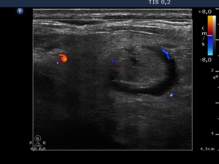 Right lobe, longitudinal scan