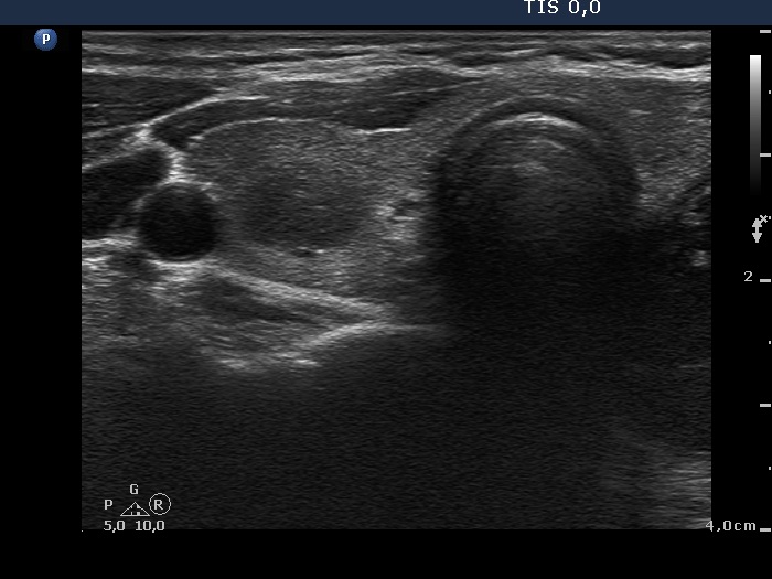 Right lobe, longitudinal scan