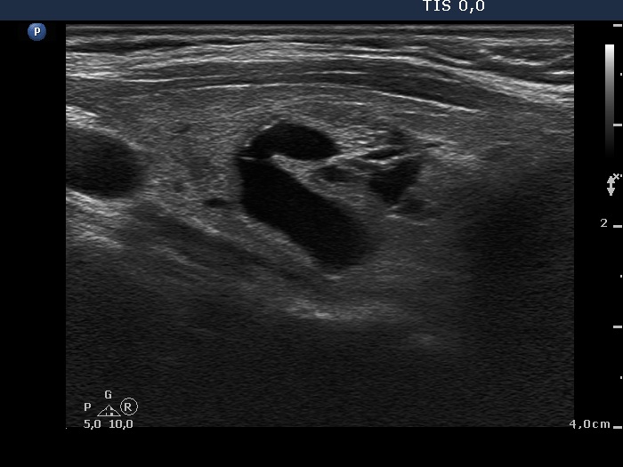 Right lobe, longitudinal scan