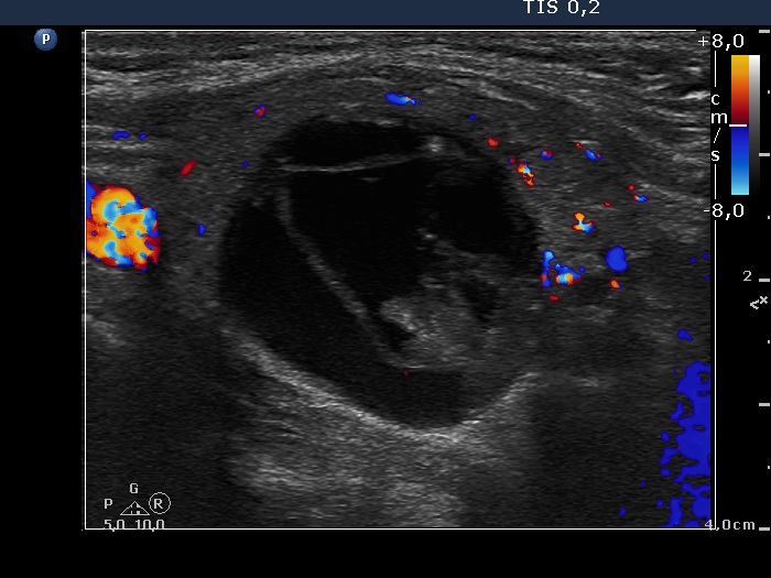 Right lobe, longitudinal scan