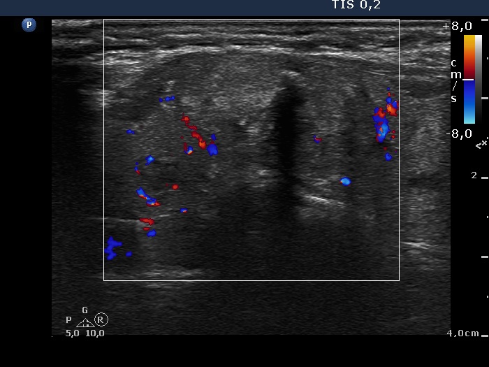 Right lobe, longitudinal scan