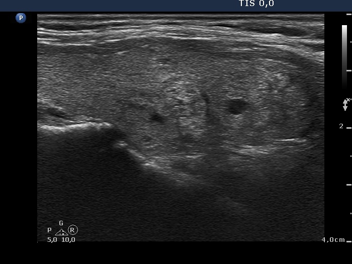Right lobe, longitudinal scan