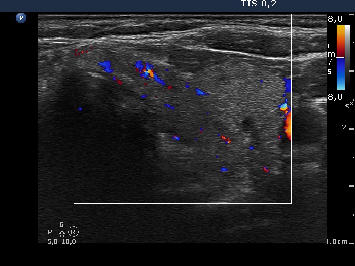 Right lobe, longitudinal scan