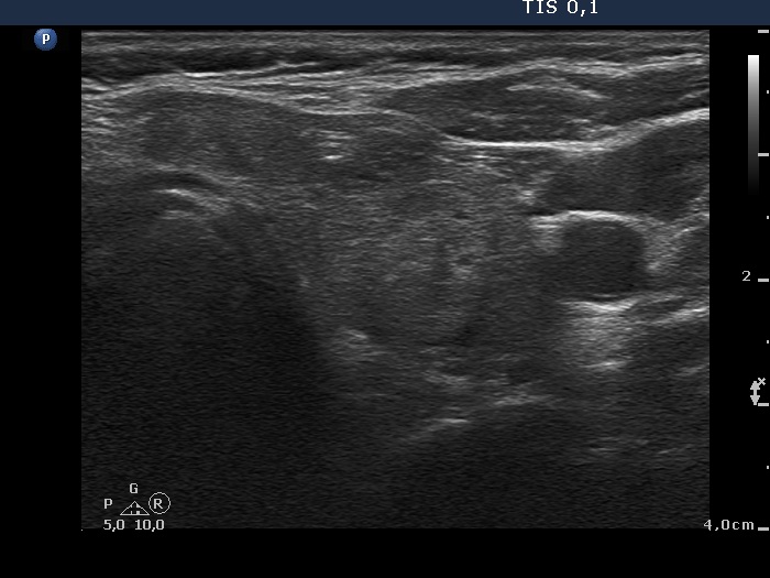 Right lobe, longitudinal scan