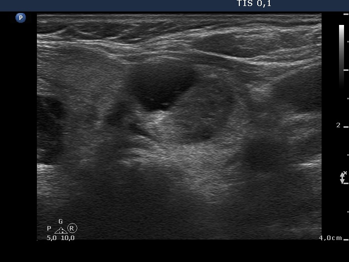 Right lobe, longitudinal scan