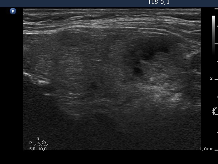 Right lobe, longitudinal scan
