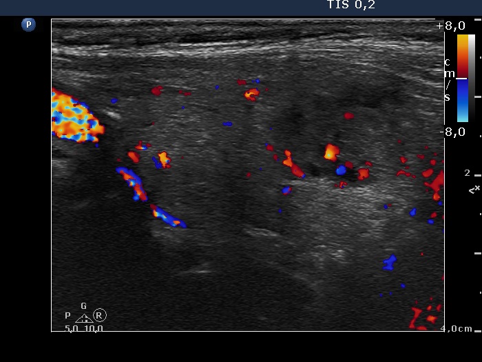 Right lobe, longitudinal scan