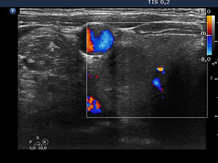 Right lobe, longitudinal scan