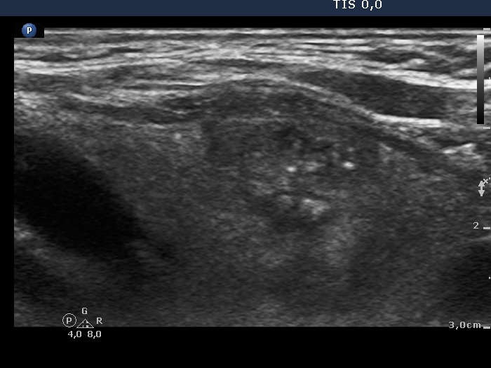 Right lobe, longitudinal scan