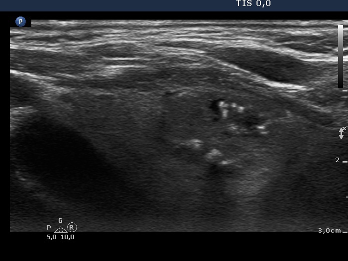 Right lobe, longitudinal scan