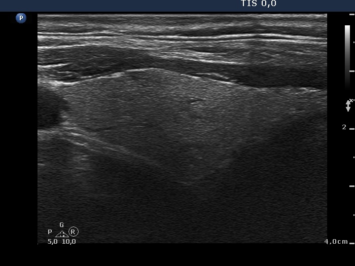 Right lobe, longitudinal scan