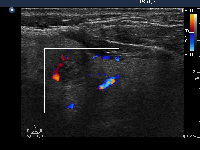 Right lobe, longitudinal scan