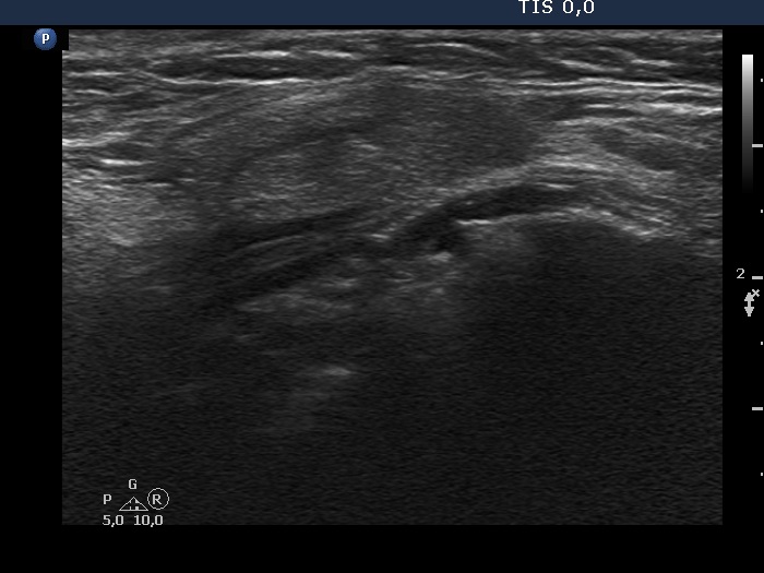 Right lobe, longitudinal scan