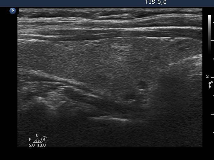 Right lobe, longitudinal scan